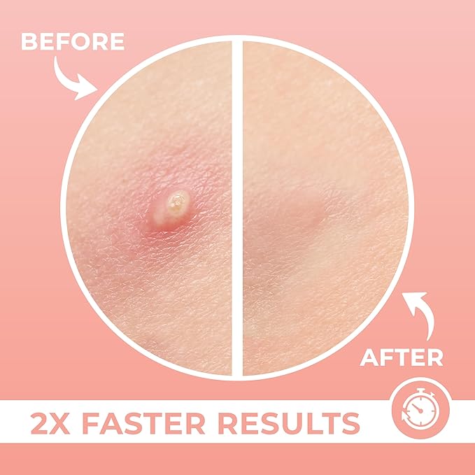 Micro Needle Pimple Patch (WS)