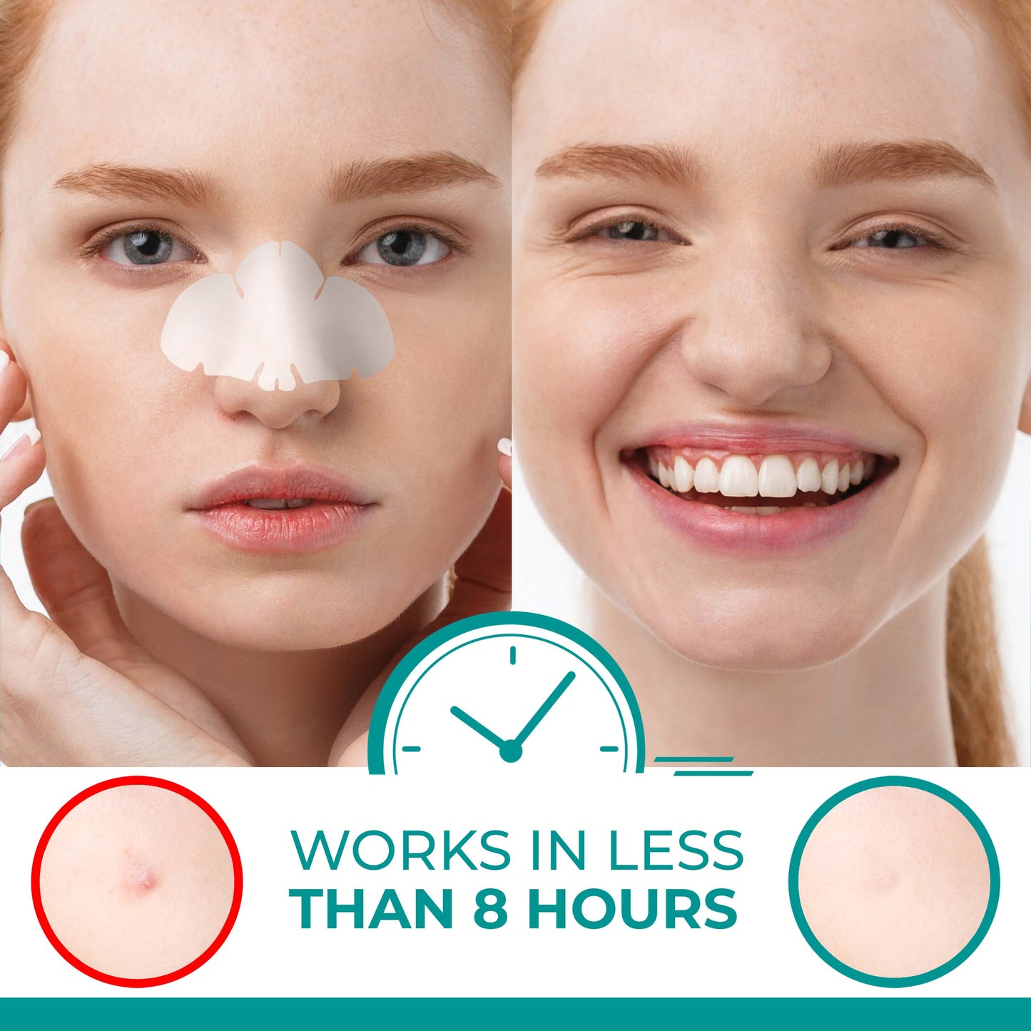 PATCHRX - NOSE PIMPLE PATCH - HYDROCOLLOID - 12 PATCHES - 6