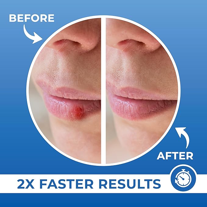 PatchRx Cold Sore Patches for Lips (20 Patches) Lysine, Calendula & Zinc – Hydrocolloid Cold Sore Patch for Lip Treatment (Overnight or Day-time Remedy), Fever Blister Patches