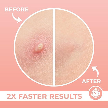 Micro Needle Pimple Patch (WS)